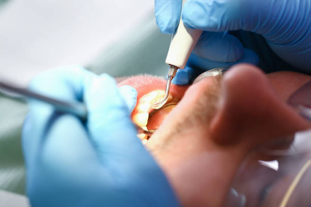 Best Emergency Root Canal Treatment in Independence, IA